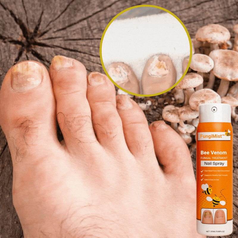 FungiMist™ Anti-Pilz-Spray | Beseitigt 99 % des Nagelpilzes in nur 3 Tagen!