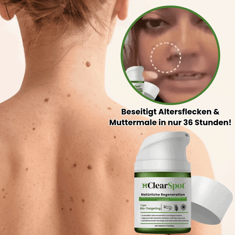 Official Store: Fivfivgo™ NatureErase Instant Mole & Spot Cream | Beseitigt Altersflecken & Muttermale in nur 36 Stunden!