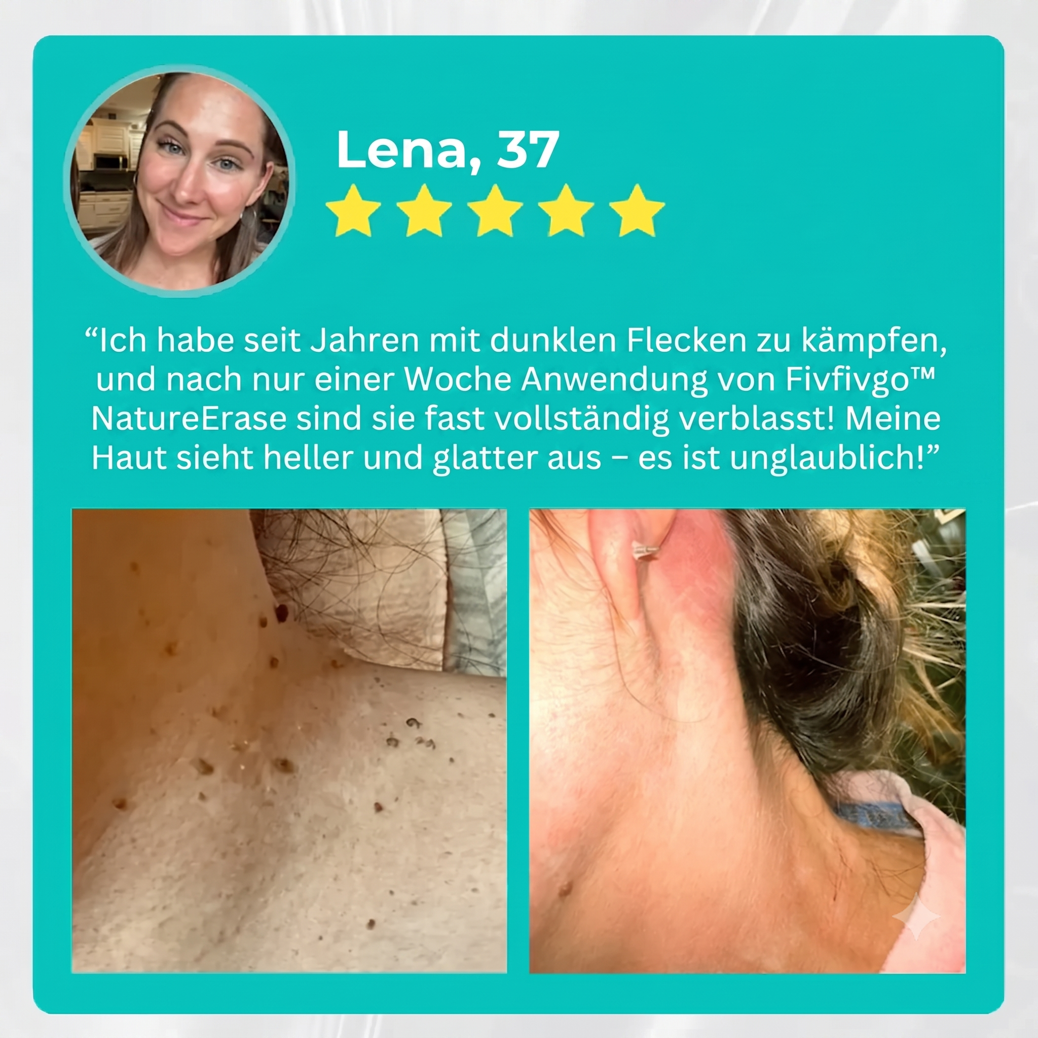 Official Store: Fivfivgo™ NatureErase Instant Mole & Spot Cream | Beseitigt Altersflecken & Muttermale in nur 36 Stunden!